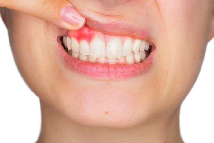 Problèmes bucco-dentaires - Gingivite