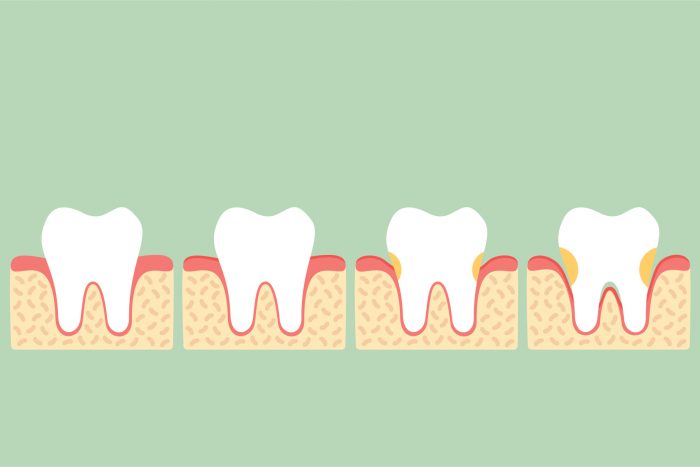 Problèmes bucco-dentaires - Parodontite
